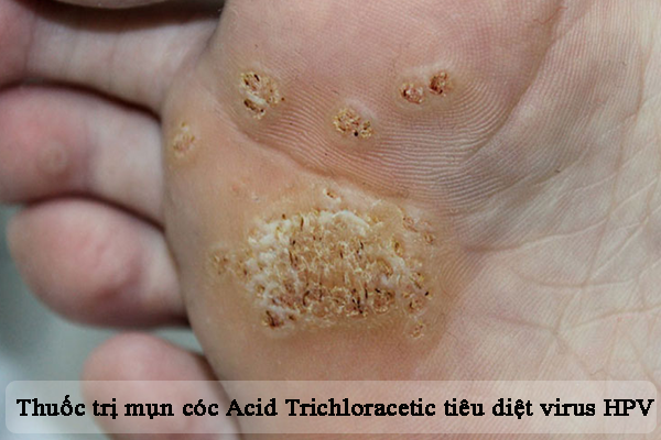 Acid Trichloracetic tiêu diệt virus HPV (nguyên nhân chính gây mụn cóc)