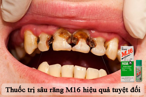 Thuốc trị sâu răng M16 hiệu quả tức thì