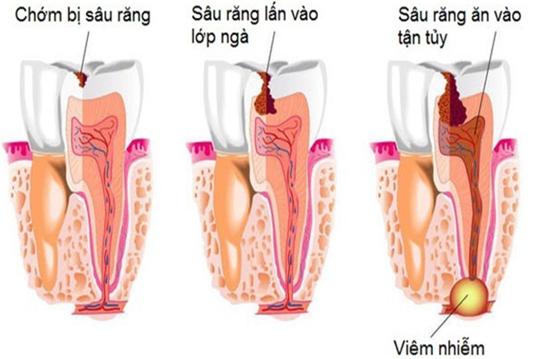 Tiến trình phát triển của bệnh sâu răng