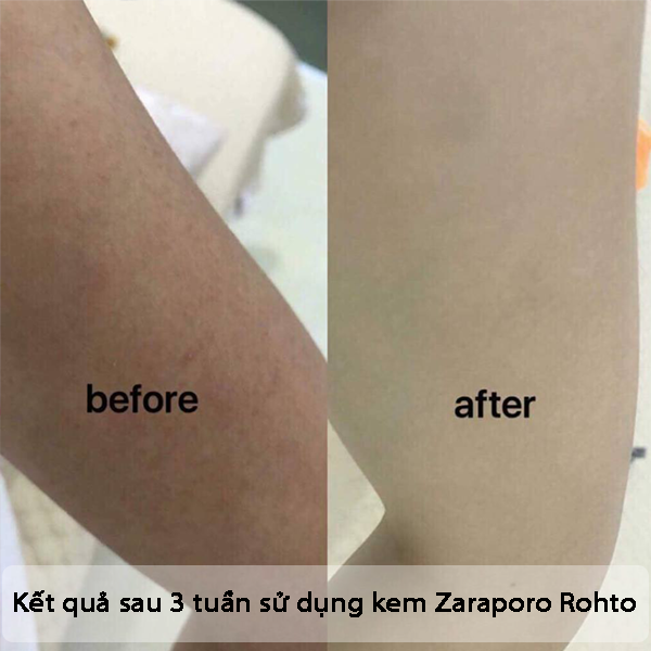 Kết quả sau 3 tuần sử dụng kem Zaraporo Rohto